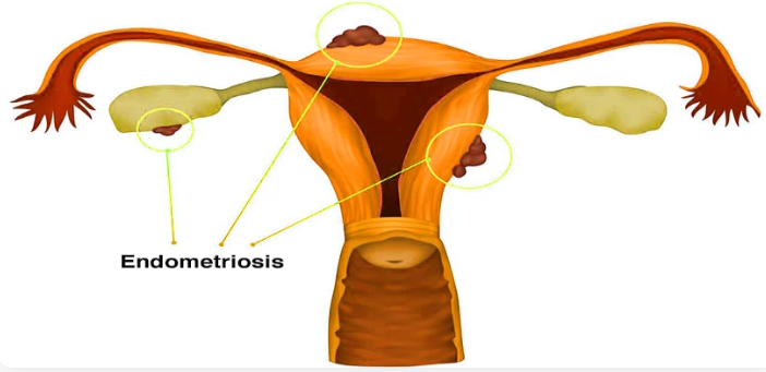 Endometriosis Treatment in Mumbai Endometriosis Treatment in Mumbai