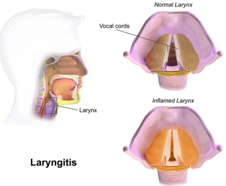 Laryngitis Treatment in Mumbai Laryngitis Treatment in Mumbai