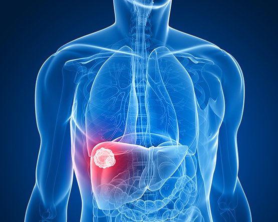 Liver Cancer Treatment in Mumbai with Dr. Ganesh Nagarajan Doctor Near Me Liver Cancer Treatment in Mumbai