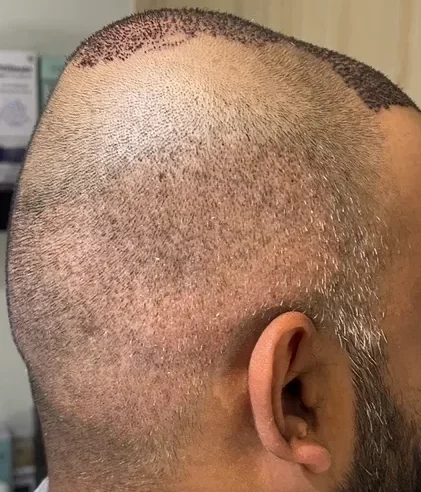 Micro FUE Hair Transplant in Mumbai with Dr. Deepam Shah at Viva Aesthetic Clinic Doctor Near Me Micro FUE Hair Transplant in Mumbai