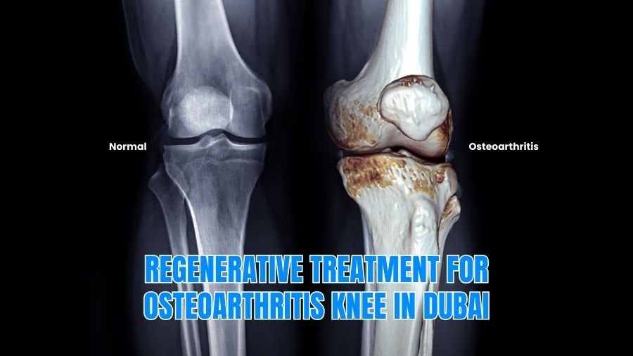 Knee Osteoarthritis Treatment in Dubai with Dr. Azam Badar Khan Doctor Near Me Knee Osteoarthritis Treatment in Dubai