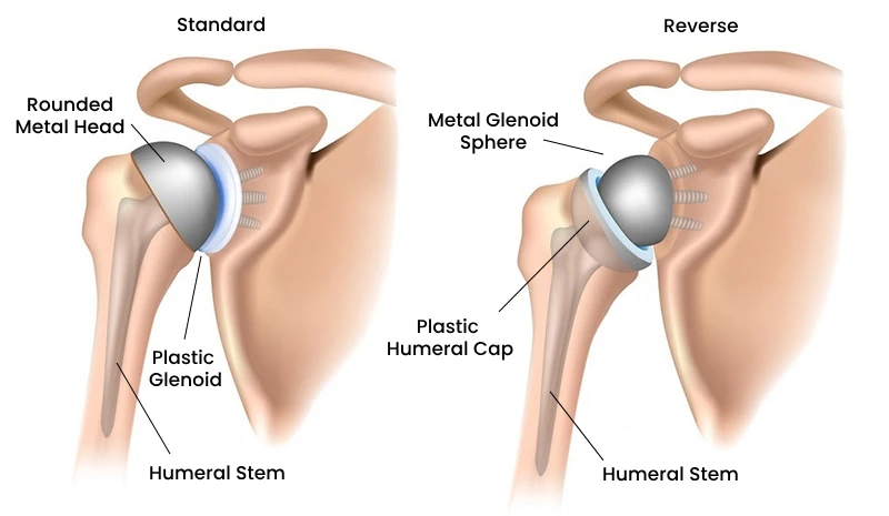 Reverse Shoulder Replacement in Bangalore | Dr. Ponnanna K.M | Orthopedic Expert Doctor Near Me Reverse Shoulder Replacement in Bangalore