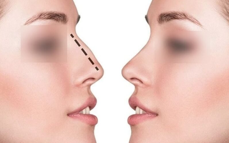 Septoplasty Surgery in Mumbai Septoplasty Surgery in Mumbai