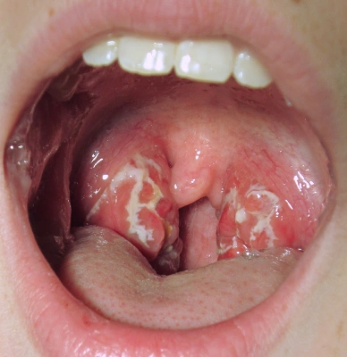 Tonsillitis Treatment in Mumbai — Expert Care with Dr. Shama Kovale Doctor Near Me Tonsillitis Treatment in Mumbai — Expert Care with Dr. Shama Kovale Doctor Near Me