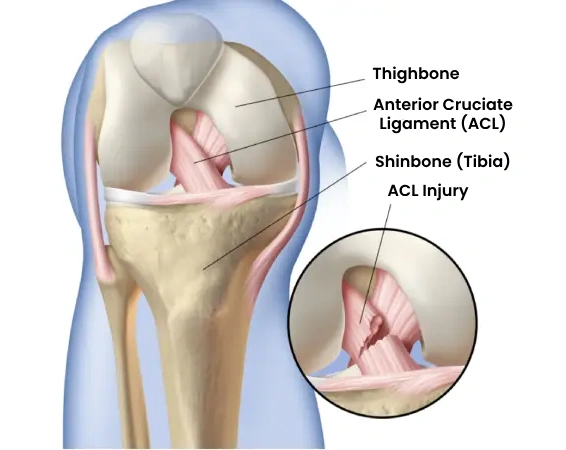 ACL Reconstruction Surgery in Dubai, UAE | Dr. Azam Badar Khan Doctor Near Me ACL Reconstruction Surgery in Dubai, UAE