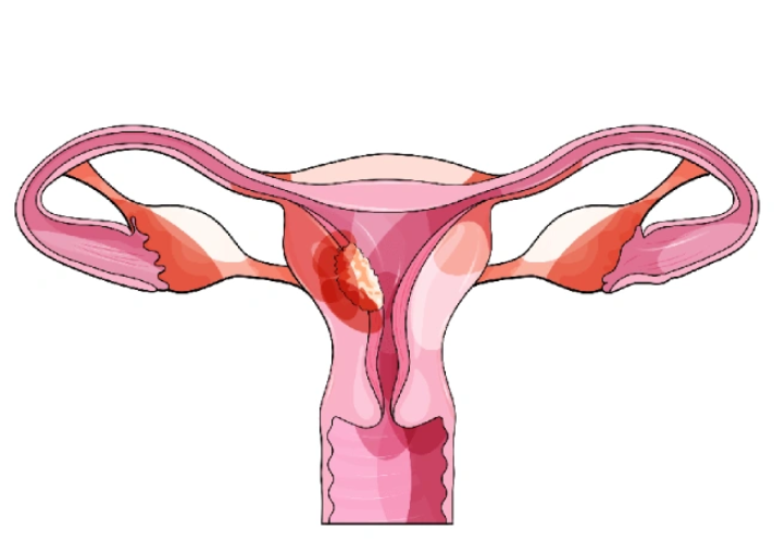 Uterine Cancer Surgery in Mumbai