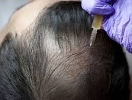 Hair Loss Treatment in Mumbai by Dr. Niketa Sonavane — Best Clinic & Procedures Doctor Near Me Hair Loss Treatment in Mumbai