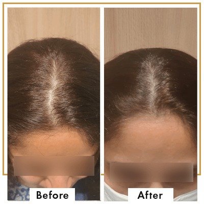 Female Hair Transplant in Mumbai with Dr. Deepam Shah at Viva Aesthetic Clinic Doctor Near Me Female Hair Transplant in Mumbai