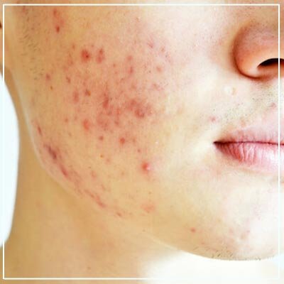Acne Treatment in Mumbai Acne Treatment in Mumbai