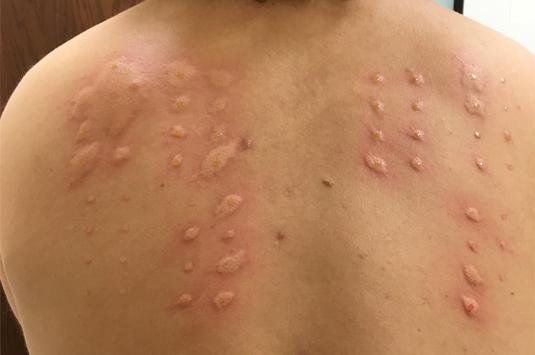 Allergy Testing in Mumbai Allergy Testing in Mumbai