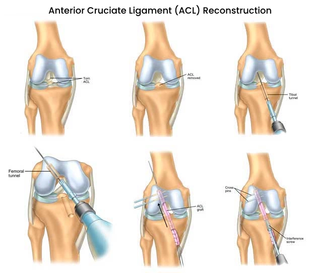 Arthroscopic ACL Reconstruction in Bangalore with Dr. Ponnanna KM Doctor Near Me Arthroscopic ACL Reconstruction in Bangalore
