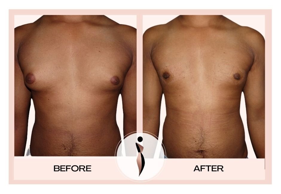 Understanding Gynecomastia Surgery in Mumbai with Dr Amiti Shah Doctor Near Me gynecomastia surgery in mumbai