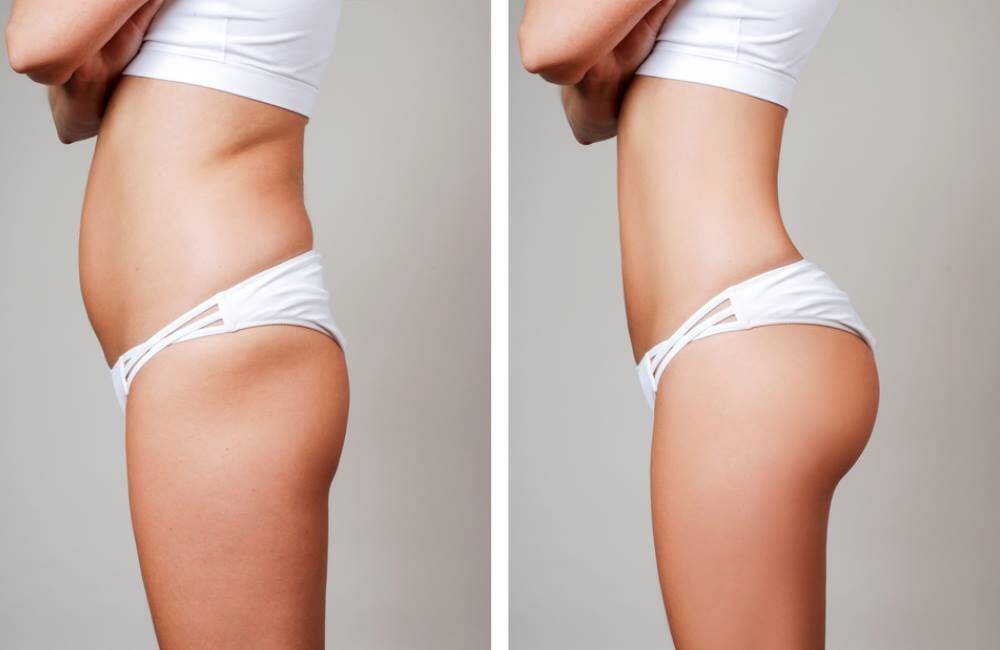 Liposuction in Mumbai, India Liposuction in Mumbai, India