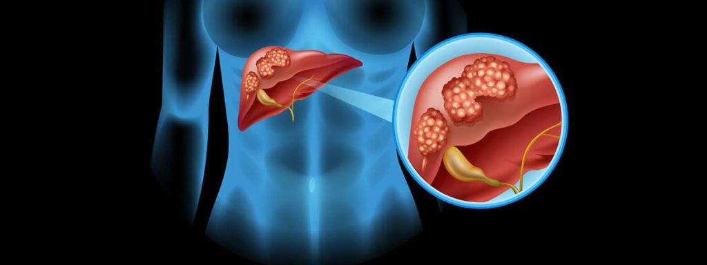 Dr. Ganesh Nagarajan – Expert Liver Cancer Surgeon in Mumbai Doctor Near Me liver cancer surgeon Mumbai