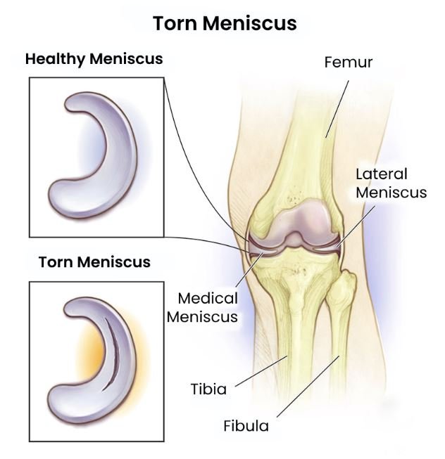 Meniscus Repair Surgery in Bangalore with Dr. Ponnanna KM Doctor Near Me Meniscus Repair Surgery in Bangalore
