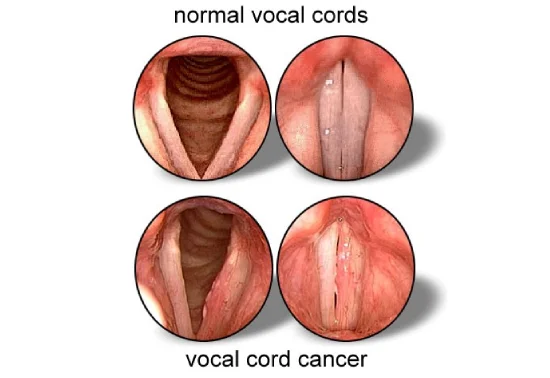 Vocal Cord Cancer Treatment in Mumbai – Expert Care with Dr. Shama Kovale Doctor Near Me Vocal Cord Cancer Treatment in Mumbai