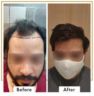 Hair-Transplant-results
