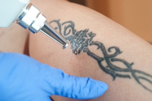Laser Tattoo removal in Mumbai