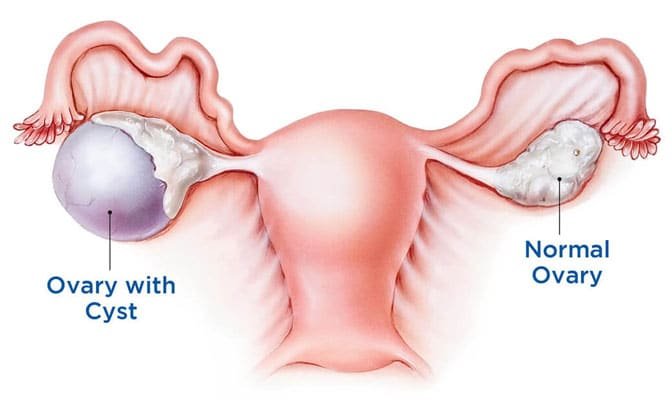 Ovarian cyst Doctor in Thane