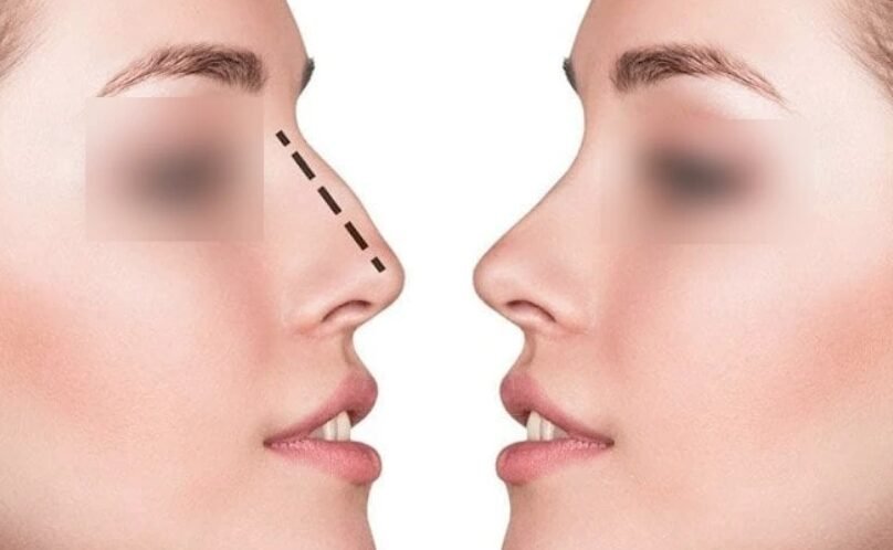 Septoplasty surgery in Mumbai
