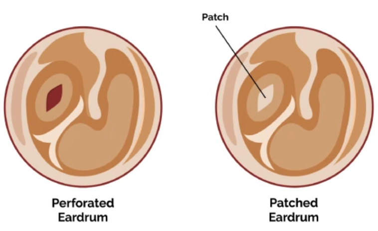 Tympanoplasty surgery in Mumbai