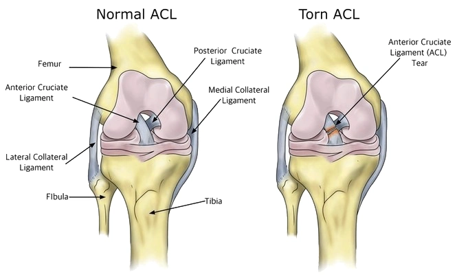 A First-Hand Look at ACL Treatment in Bangalore Doctor Near Me ACL Treatment in bengalore