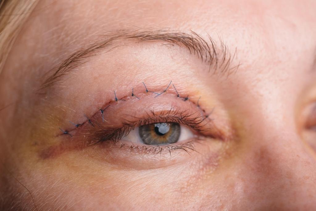 Eyelid Surgery in Mumbai