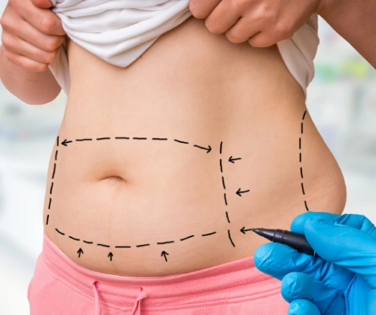 Liposuction Surgery in Mumbai