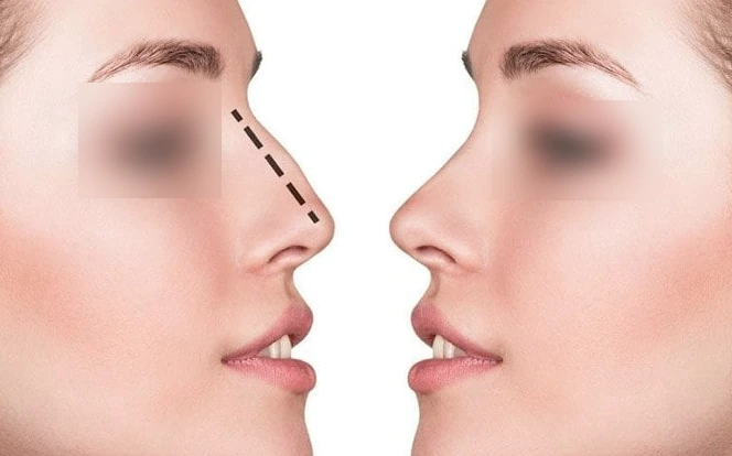 A Medical Journalist’s Perspective on Septoplasty Surgery in Mumbai Doctor Near Me Septoplasty Surgery in Mumbai