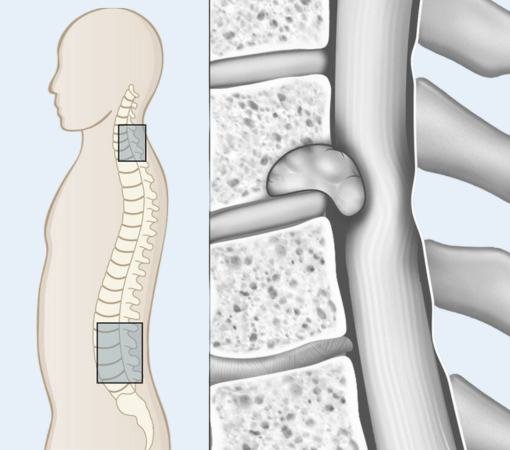 A First-Hand Clinical View of Spinal Cord Tumor Treatment in Mumbai Doctor Near Me Spinal Cord Tumor Treatment in Mumbai