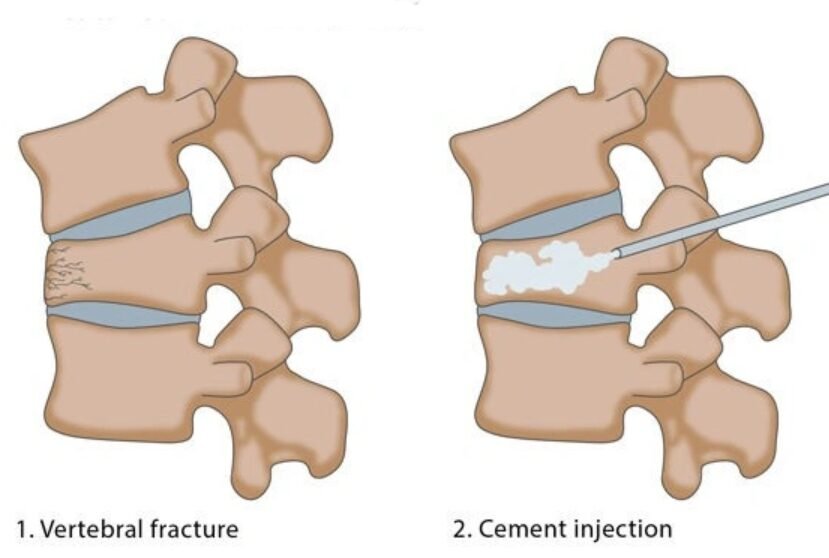 Vertebroplasty Surgery in Mumbai Vertebroplasty Surgery in Mumbai