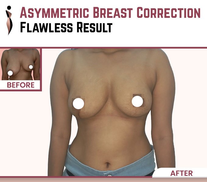 A First-Hand Clinical Perspective on Breast Asymmetry Correction in Mumbai Doctor Near Me Breast Asymmetry Correction in Mumbai