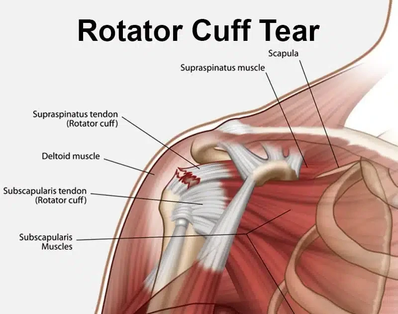 Arthroscopic Rotator Cuff Repair in Bangalore