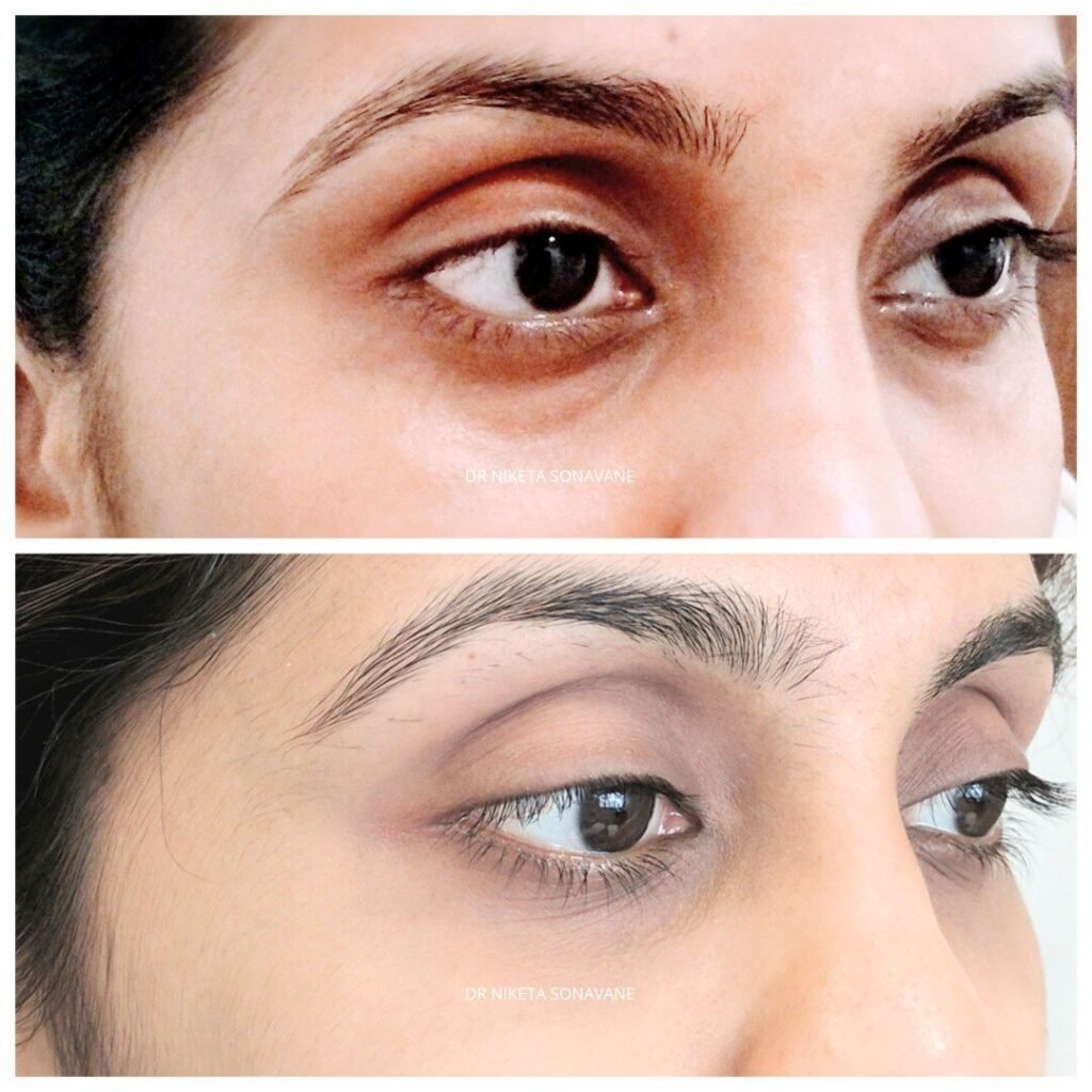 Understanding Dark Circles: A Clinical Perspective From a Mumbai Dermatology Clinic Doctor Near Me dark circle removal in mumbai