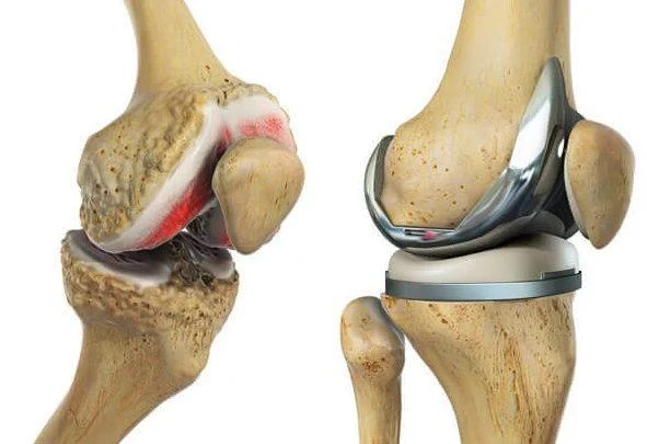 Knee Replacement in Banglalore