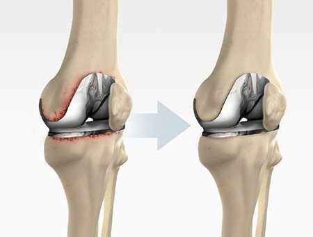Revision Knee Replacement in Bangalore