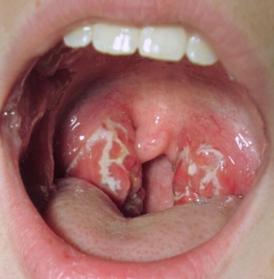 Tonsillitis treatment in Mumbai Tonsillitis treatment in Mumbai