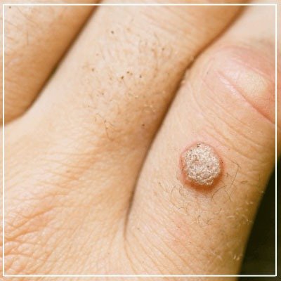 Best wart removal treatment in Mumbai