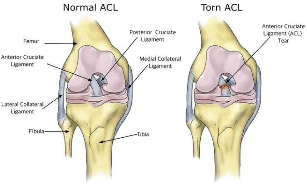 ACl treatment in Bangalore