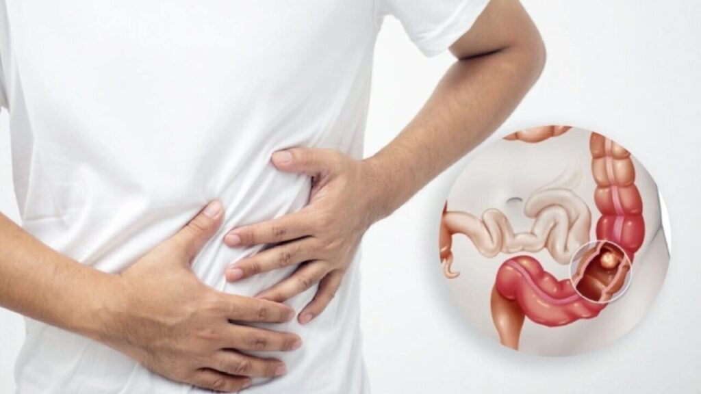 Colon Cancer in Younger Adults