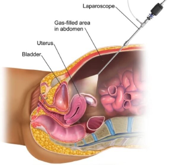 Laparoscopic hysterectomy in Mumbai Laparoscopic hysterectomy in Mumbai