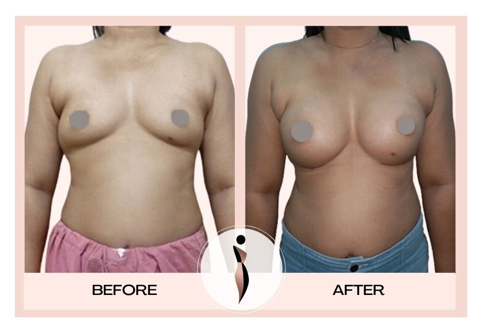 breast augmentation mumbai