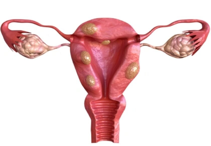 Fibroid removal in Mumbai