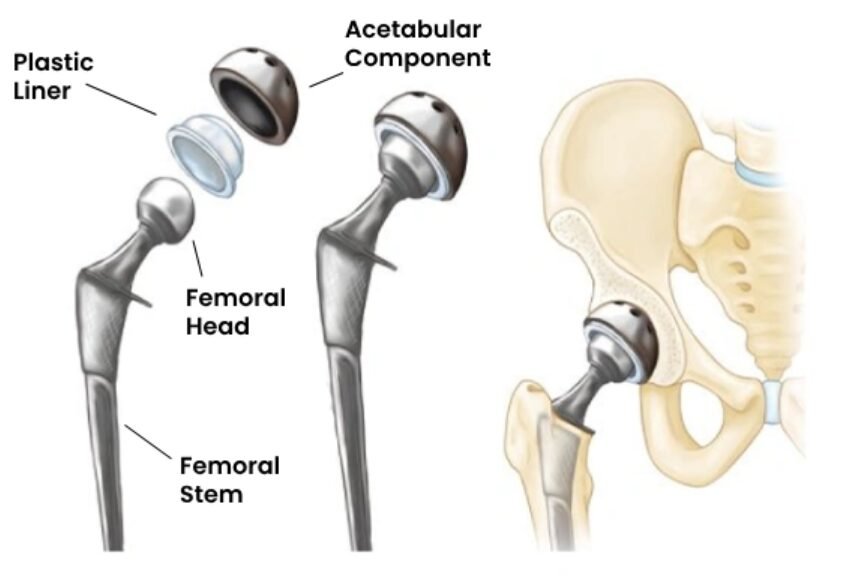 Hip replacement in Bangalore