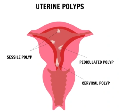 hysteroscopic polypectomy in mumbai