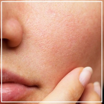 Open pores treatment in Mumbai