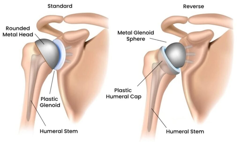 Reverse Shoulder Replacement in Bangalore
