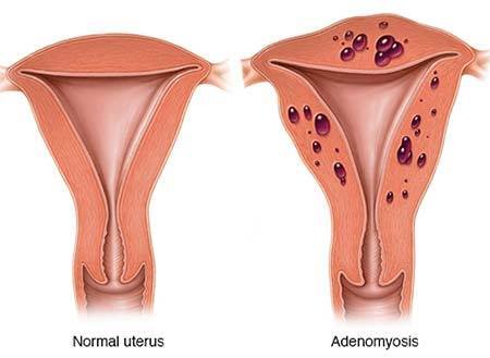 adenomyosis treatment in mumbai