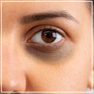 dark circles treatment in mumbai