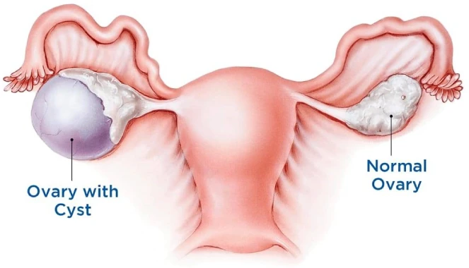 ovarian cystectomy in mumbai